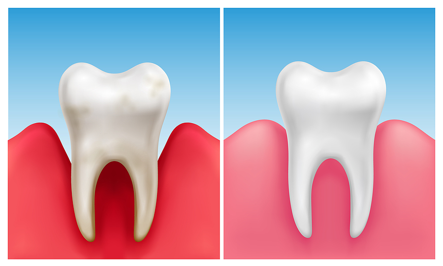 Comprehensive Care for Gum Disease in Colorado Springs, CO