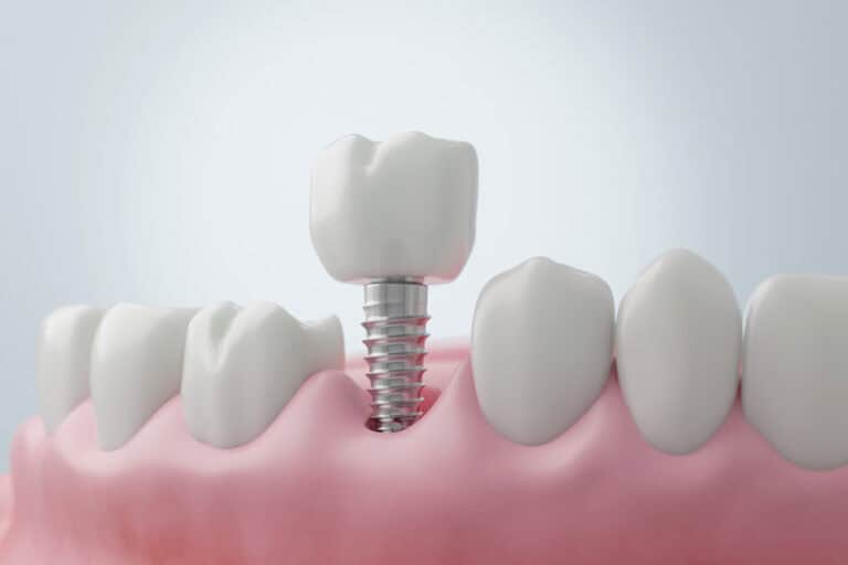 3D illustration of dental implant screw placed in jawbone for bone grafting procedure