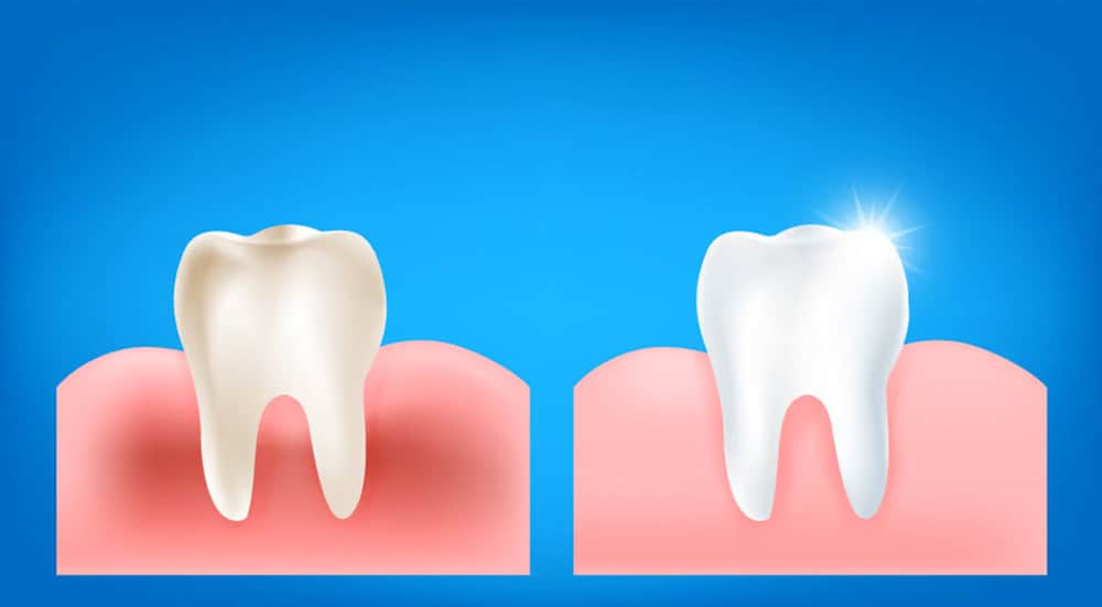 Gum Disease in Colorado Springs CO
