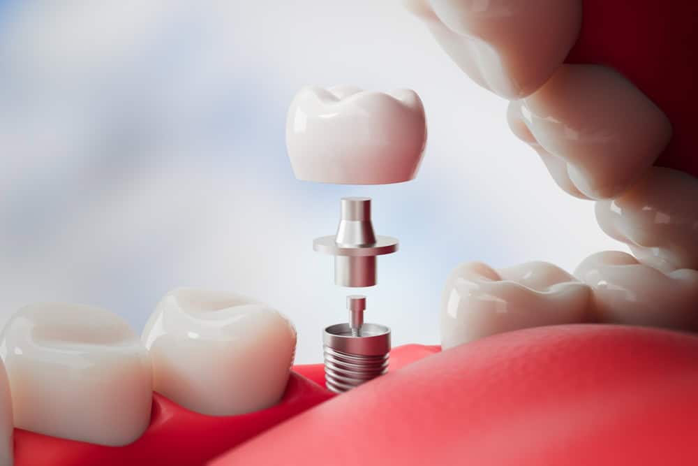 Implant Restoration in Colorado Springs CO