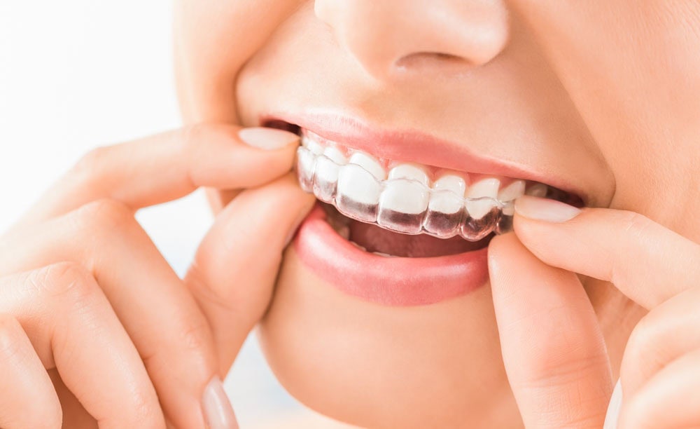 Invisalign in Colorado Springs CO